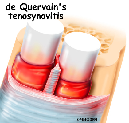 de Quervain's Tenosynovitis
